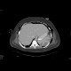 Infarctions of spleen: CT - Computed tomography
